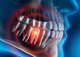 انواع علت تشخیص عوارض و درمان دندان نهفته