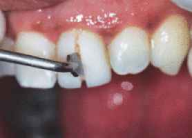 معایب و عوارض لمینت دندان