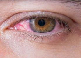 خشکی چشم و راه هایی برای درمان آن