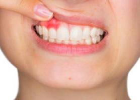 علل و رایج‌ترین انواع ترومای دندان