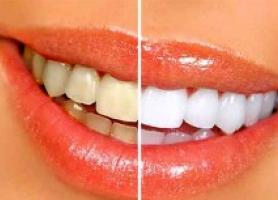 زردی دندان ها نشانه چیست ؟