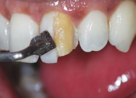 تفاوت کامپوزیت با لمینت دندان
