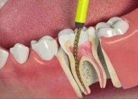 مراحل عوارض هزینه و زمان مناسب عصب کشی دندان
