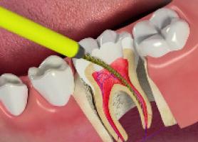 درمان ریشه دندان مراحل عصب کشی و سوالات متداول