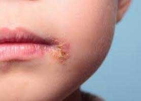 بیماری زرد زخم در کودکان چیست؟