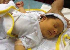 روش تشخیص زردی در نوزادان